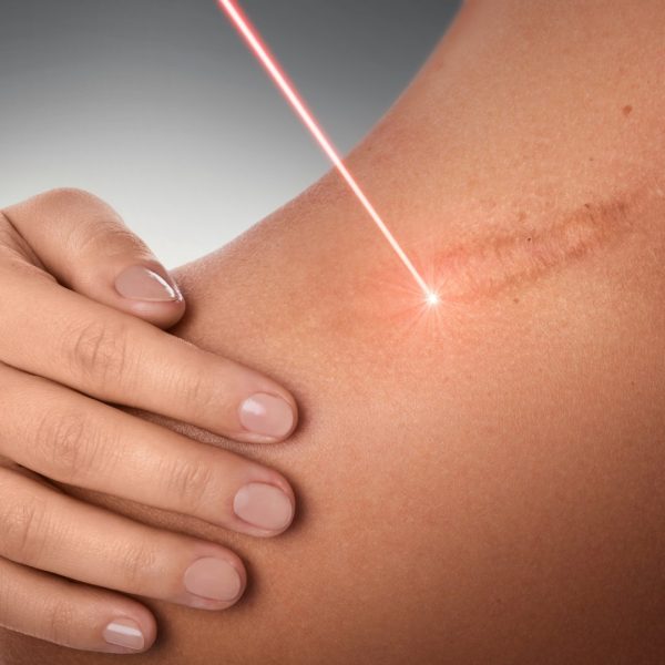 uklanjanje ožiljaka laserom